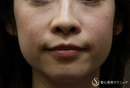症例写真 術前 プレミアムPRP皮膚再生療法＋ウルセラシステム