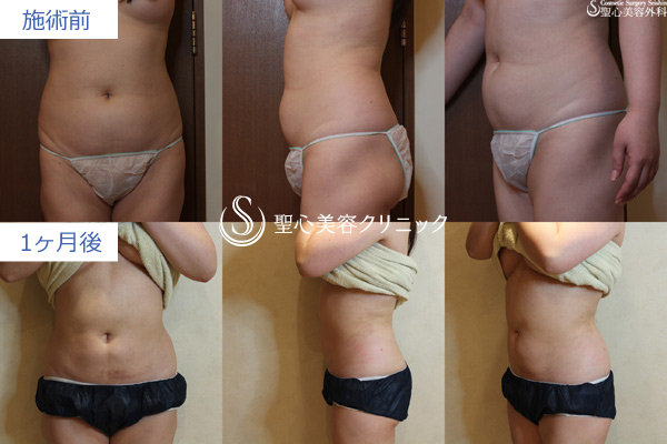 ベイザーリポ2.2脂肪吸引の症例写真