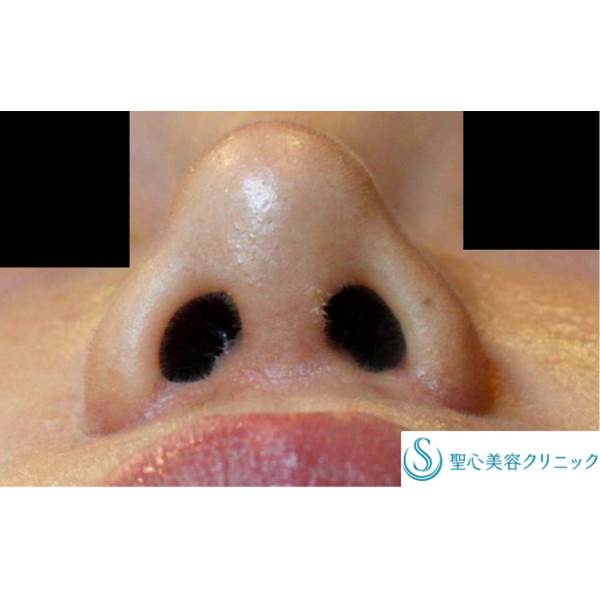 症例写真 術後 鼻の整形