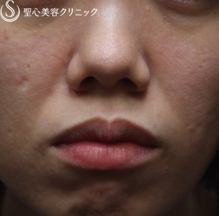 症例写真 術前 プレミアムPRP皮膚再生療法