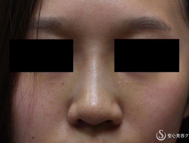 症例写真 術後 鼻のプロテーゼ＋耳介軟骨