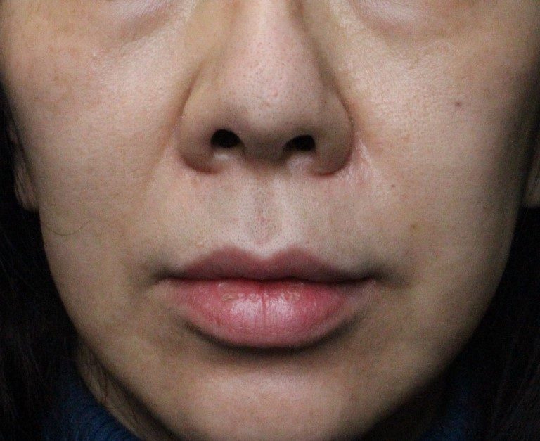 症例写真 術後 鼻孔縁複合組織移植術