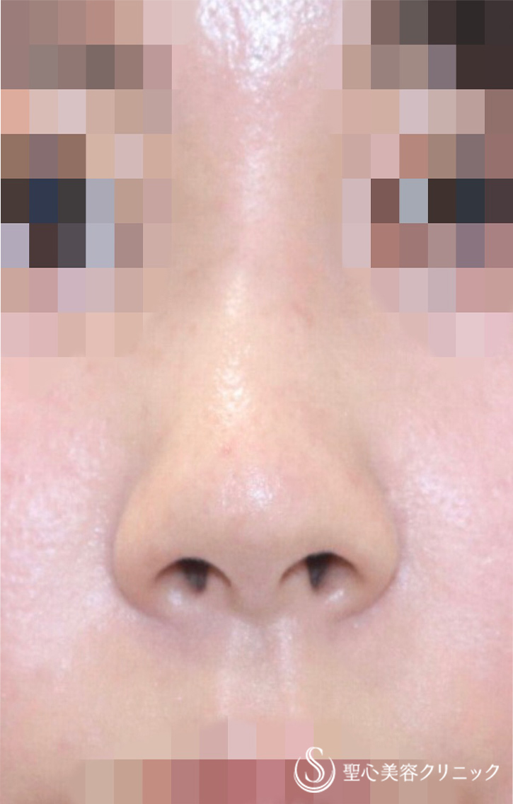 鼻の整形の症例写真 聖心美容クリニック東京院