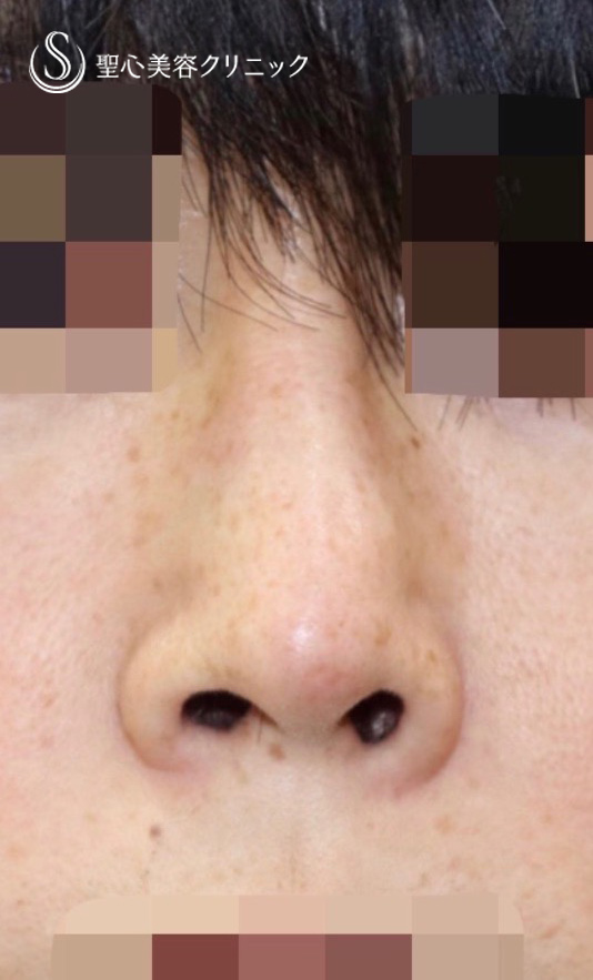 鼻の整形 鼻先 の症例写真 聖心美容クリニック東京院