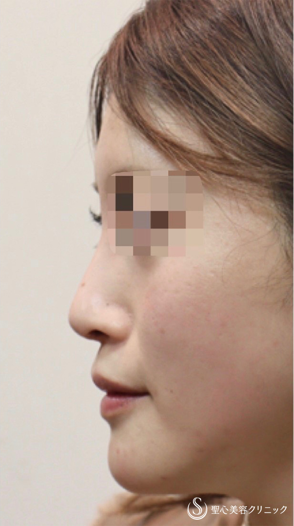 鼻の整形 わし鼻 の症例写真 聖心美容クリニック東京院