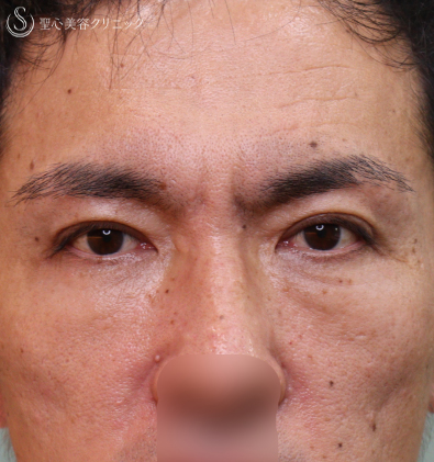 プレミアムPRP皮膚再生療法+眉下切開法（眉下リフト）