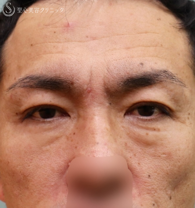 プレミアムPRP皮膚再生療法+眉下切開法（眉下リフト）Before