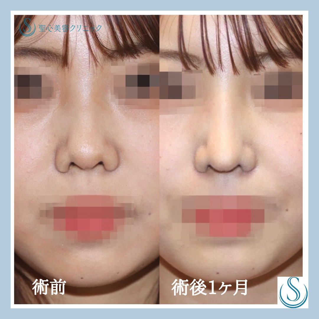 鼻中隔延長術＋プロテーゼによる隆鼻術＋鼻尖縮小_After